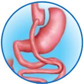 Illustration of a Gastric Bypass