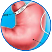 Illustration of Gastric Banding