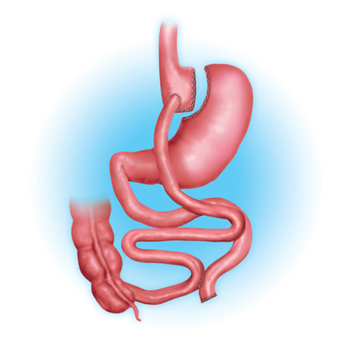 Gastric Bypass Surgery in Corpus Christi & Victoria Texas