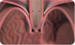 Tif Transoral Incisionless Fundoplication For Gerd Victoria Corpus Christi Texas Tif Transoral Incisionless Fundoplication For Gerd Victoria Corpus Christi Texas