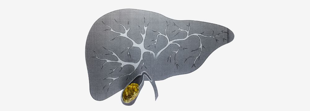 Diagram of illustrated Gallbladder containing gallstones 